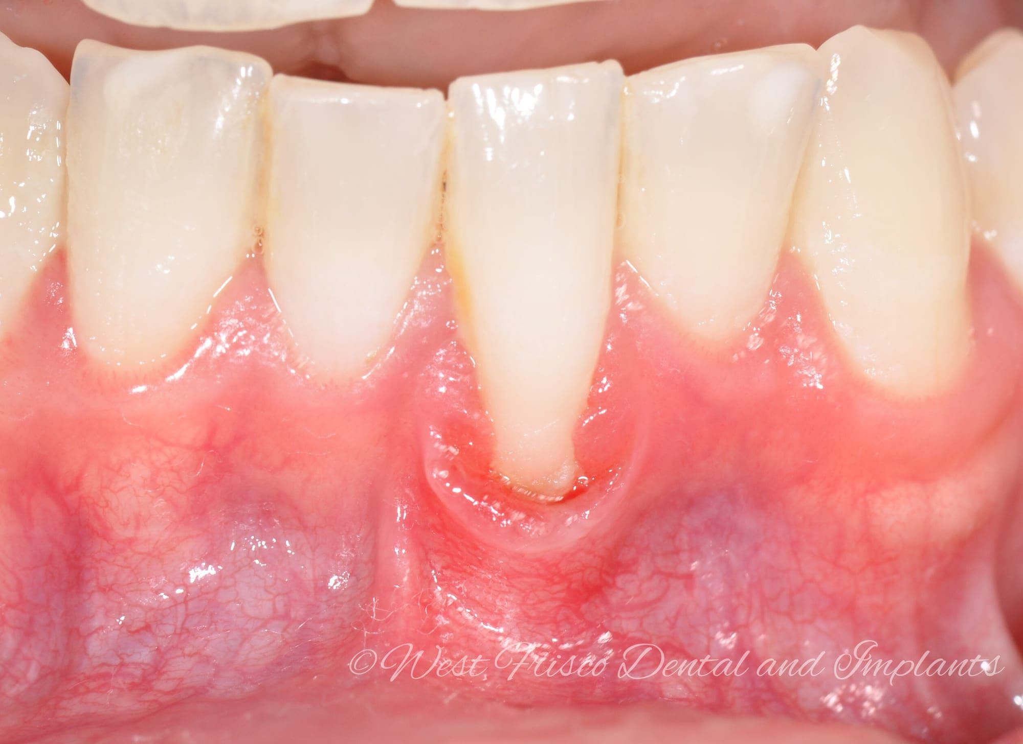 Gum graft for recession - before