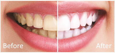 Zoom teeth whitening before and after in Frisco