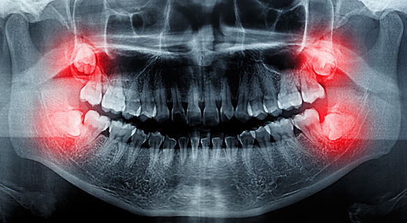 Wisdom teeth extractions in Frisco